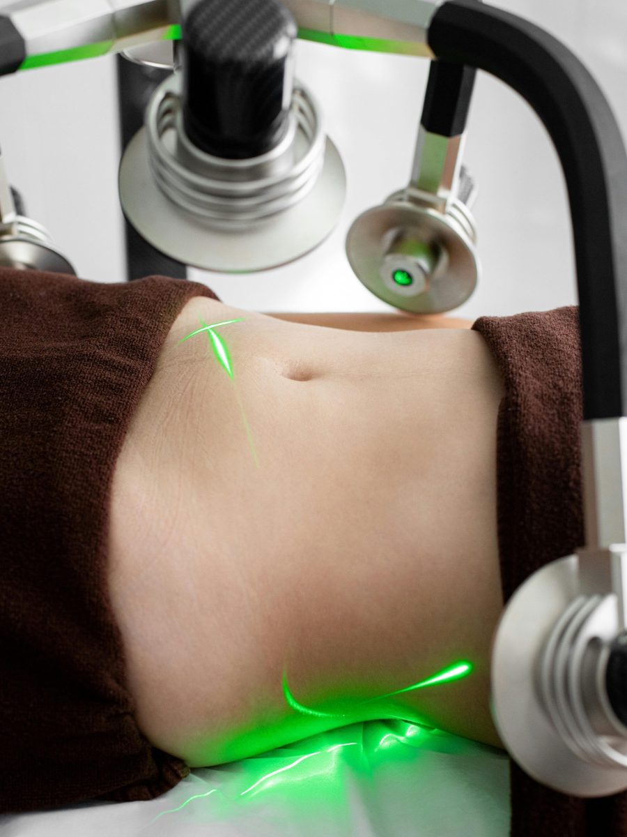 Close-up of a woman's abdomen during a laser liposuction treatment in a medical facility.